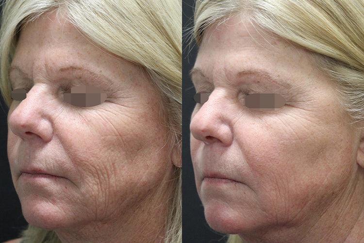 Completely New Ways to Treat Your Wrinkles in Bakersfield