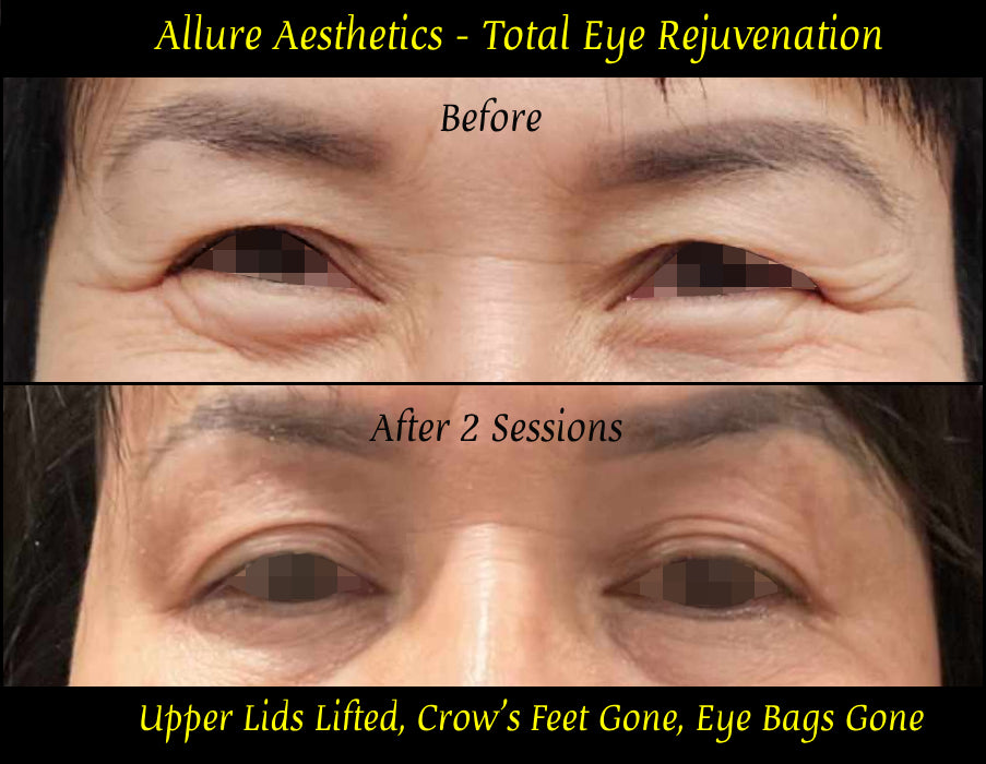 Total Eye Rejuvenation
