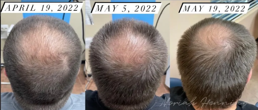 Microchanneling Hair Restoration Reversed Balding In Just 1 Month
