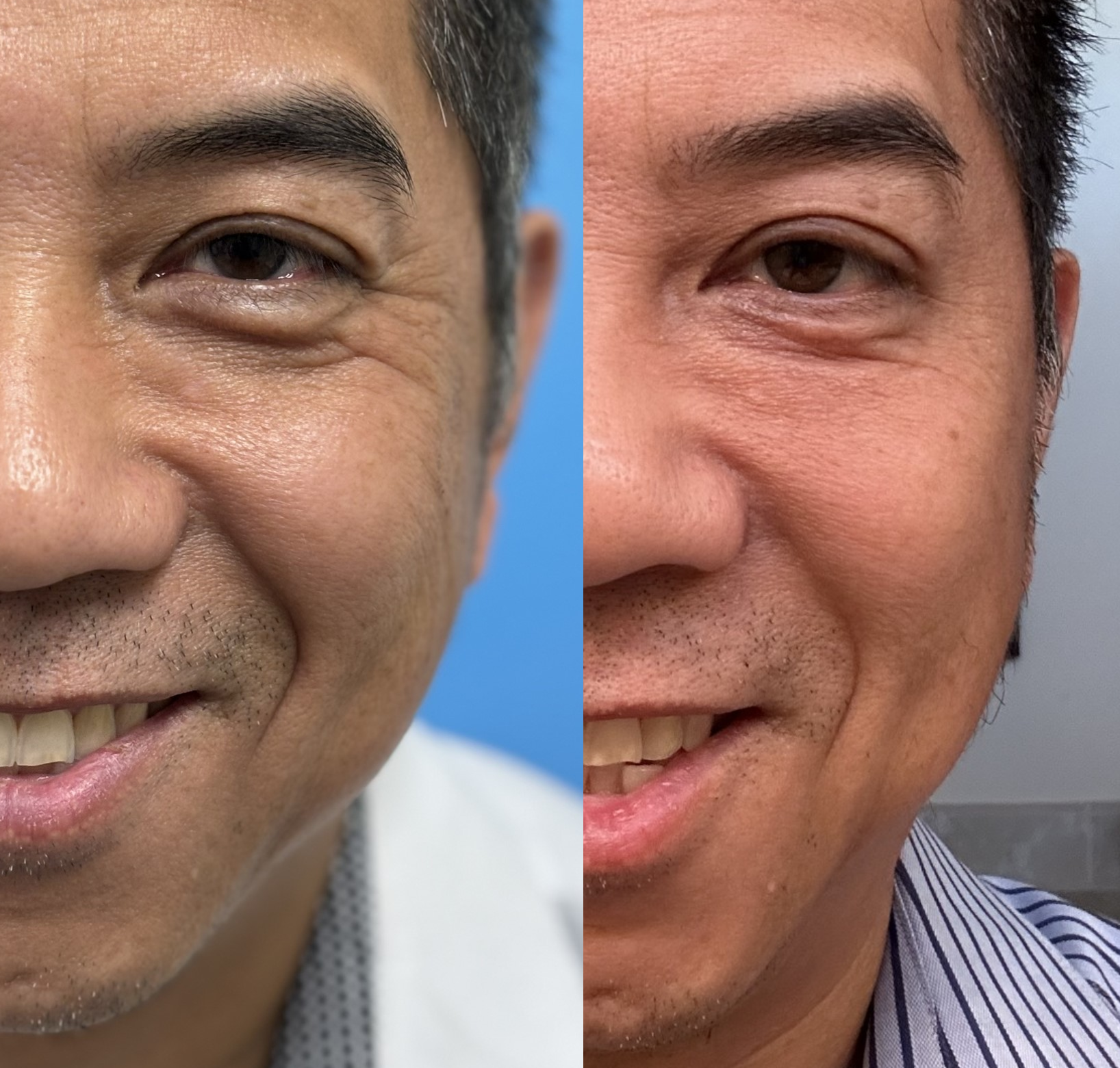 Crow's Feet and Eye Bags Deflated