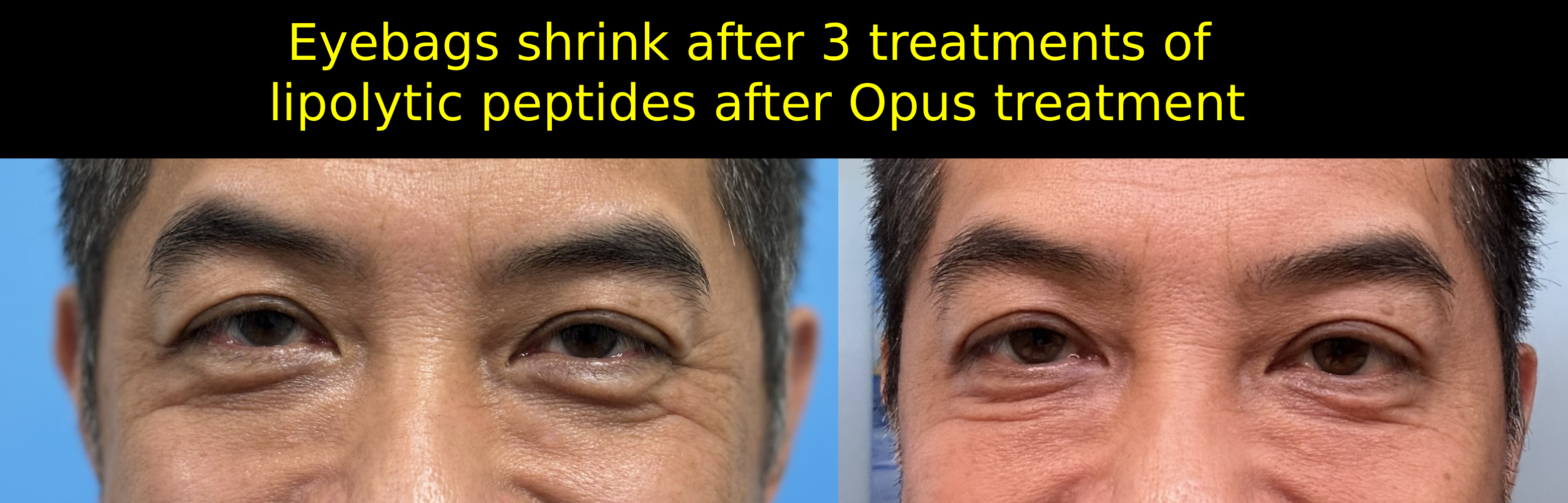Eye Bags Treatment - No Surgery