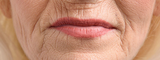 Smoker's Lines or Lipstick Lines