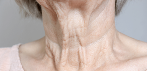 Turkey Neck Treatment