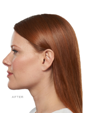 Kybella is the non-surgical procedure to reduce double chin to sharpen up the jawline once again.