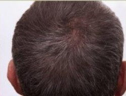 PRP Hair Restoration uses your own growth factors in your plasma to promote hair regrowth from your natural hair follicles.  This is not hair transplantation.