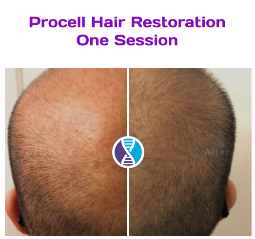 Procell Microchanneling - Hair Regrowth with Stem Cell Growth Factors