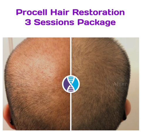 Procell Microchanneling - Hair Regrowth with Stem Cell Growth Factors (3 Session Package)