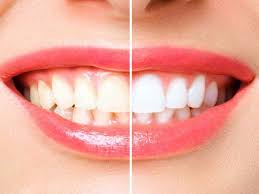 Teeth Whitening Online Special
